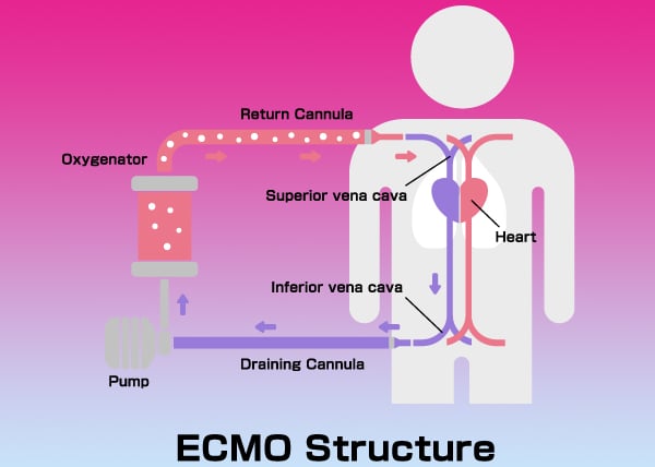 cca-VA-ECMO 2.jpg