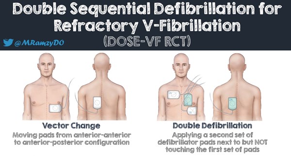 Critical Care Alert: Defibrillation Strategies for Refractory