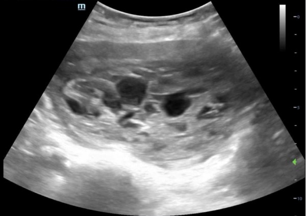 Molar Pregnancy - Fig 1.jpg