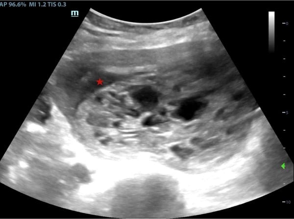 Molar Pregnancy - Fig 2.jpeg