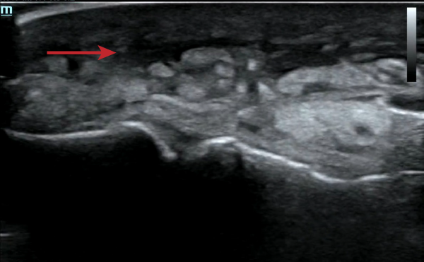 Nec Fasc - Suprafascial plane anechoic fluid w arrow.png